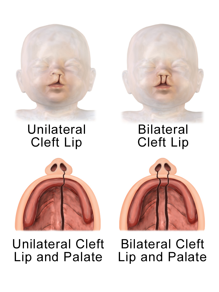 Ep Cleft Lip Palate And Jack S New Smile The Storytime Clinic